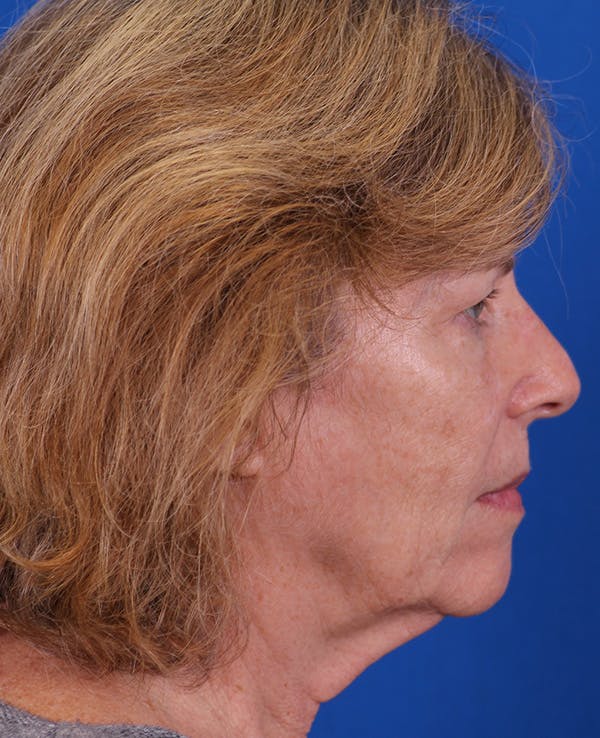 Facelift/Neck Lift Before & After Gallery - Patient 200239 - Image 5
