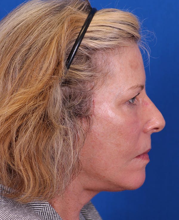 Facelift/Neck Lift Before & After Gallery - Patient 200239 - Image 6