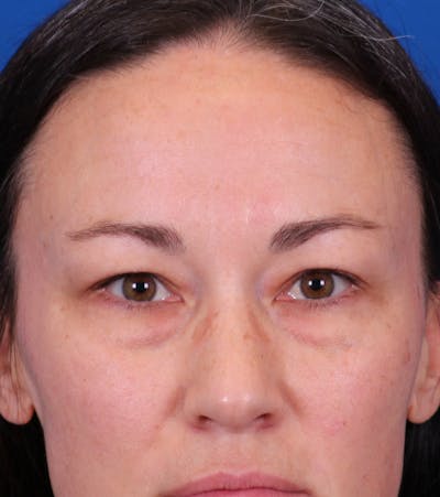 Blepharoplasty Before & After Gallery - Patient 105485 - Image 1