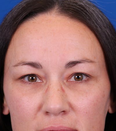 Blepharoplasty Before & After Gallery - Patient 105485 - Image 2