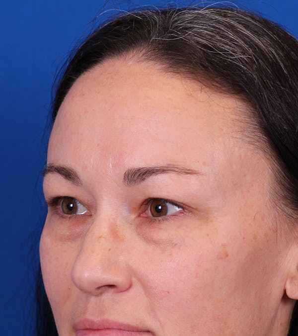 Blepharoplasty Before & After Gallery - Patient 105485 - Image 3