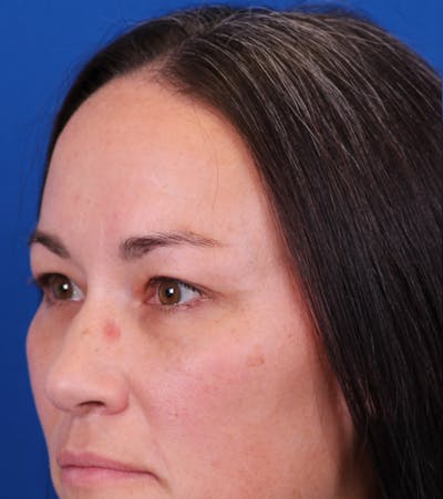 Blepharoplasty Before & After Gallery - Patient 105485 - Image 4