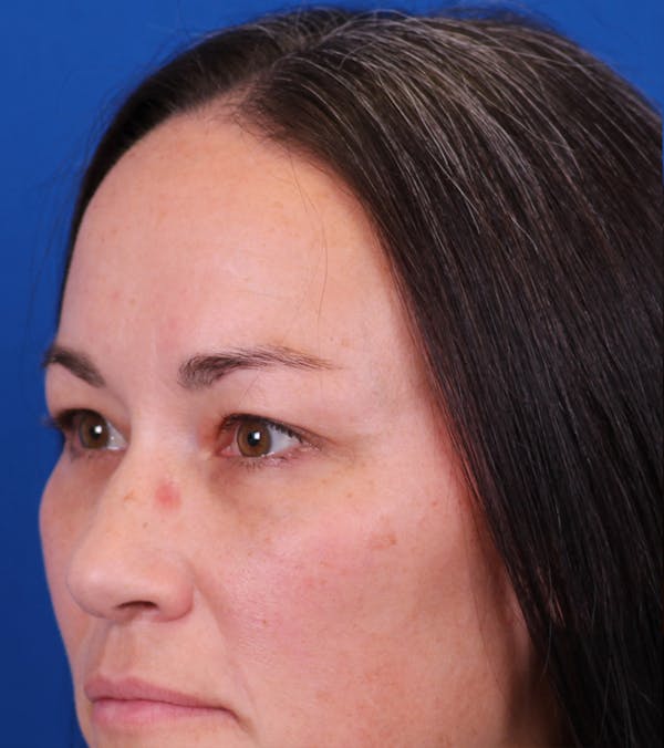 Blepharoplasty Before & After Gallery - Patient 105485 - Image 4