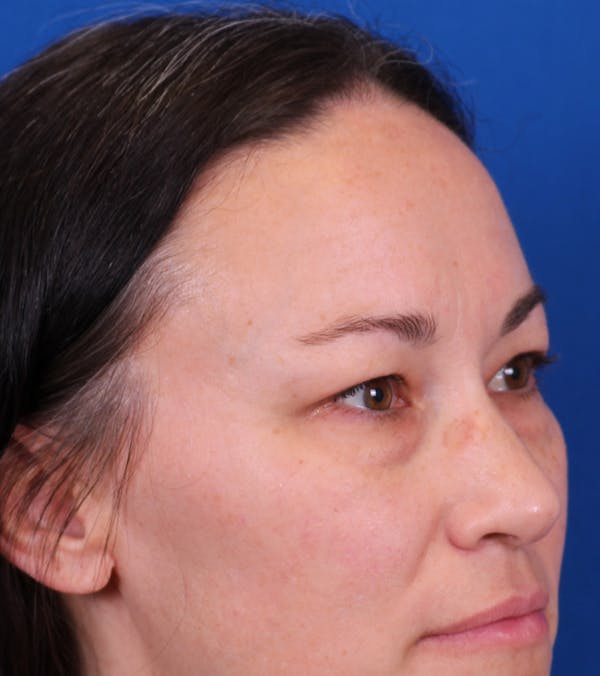 Blepharoplasty Before & After Gallery - Patient 105485 - Image 5
