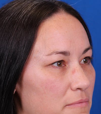 Blepharoplasty Before & After Gallery - Patient 105485 - Image 6