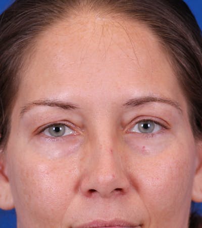Blepharoplasty Before & After Gallery - Patient 178597 - Image 1