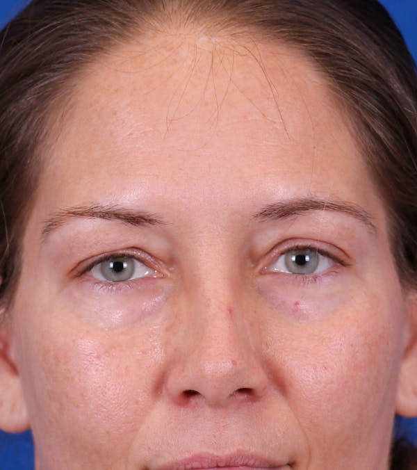 Blepharoplasty Before & After Gallery - Patient 178597 - Image 1