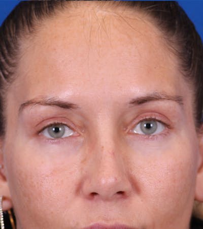 Blepharoplasty Before & After Gallery - Patient 178597 - Image 2