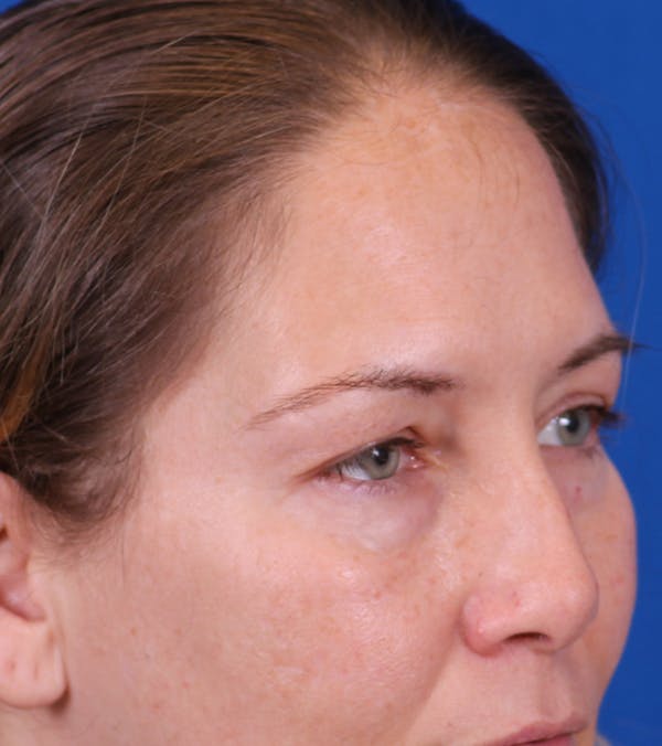 Blepharoplasty Before & After Gallery - Patient 178597 - Image 3