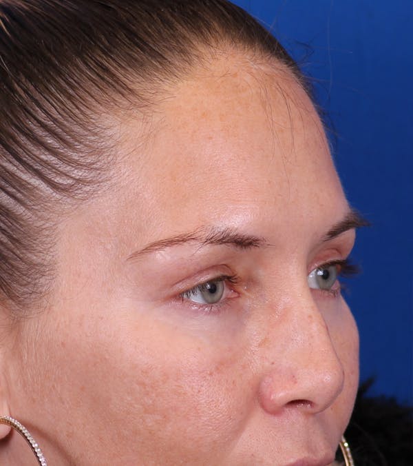 Blepharoplasty Before & After Gallery - Patient 178597 - Image 4