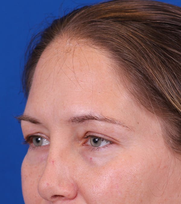 Blepharoplasty Before & After Gallery - Patient 178597 - Image 5
