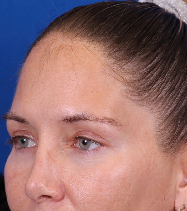 Blepharoplasty Before & After Gallery - Patient 178597 - Image 6