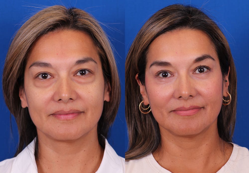 Blepharoplasty Before & After Gallery - Patient 165779 - Image 1
