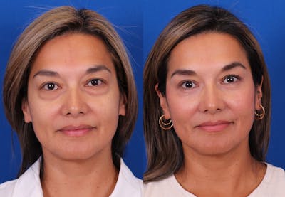 Blepharoplasty Before & After Gallery - Patient 165779 - Image 1