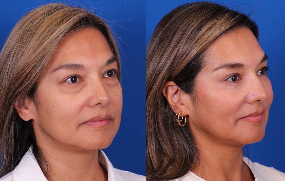 Blepharoplasty Before & After Gallery - Patient 165779 - Image 2