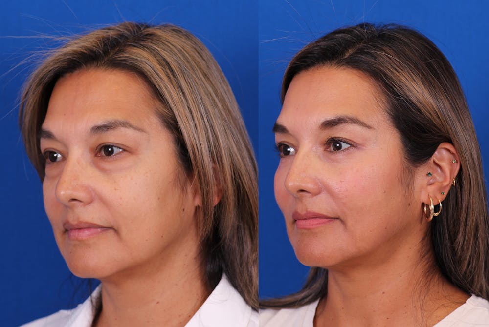 Blepharoplasty Before & After Gallery - Patient 165779 - Image 3