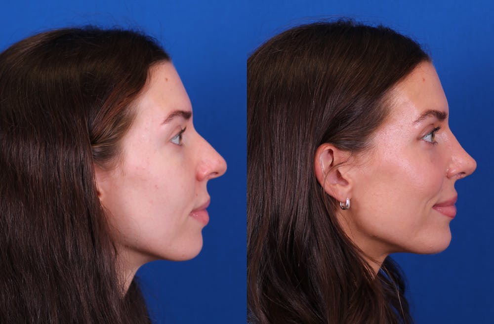 Rhinoplasty Before & After Gallery - Patient 272074 - Image 1