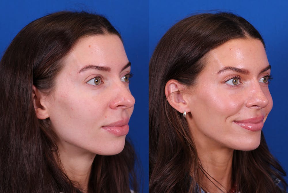 Rhinoplasty Before & After Gallery - Patient 272074 - Image 2