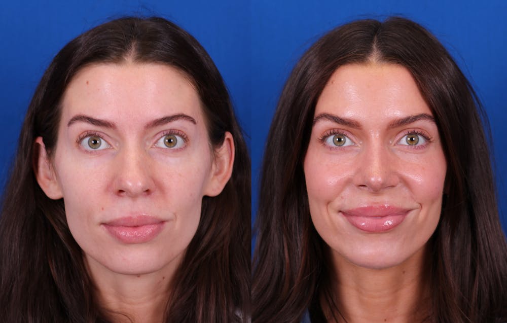 Rhinoplasty Before & After Gallery - Patient 272074 - Image 3