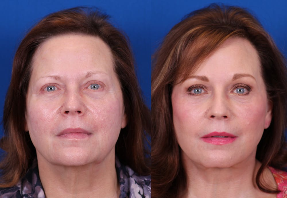 Brow Lift Before & After Gallery - Patient 405442 - Image 1