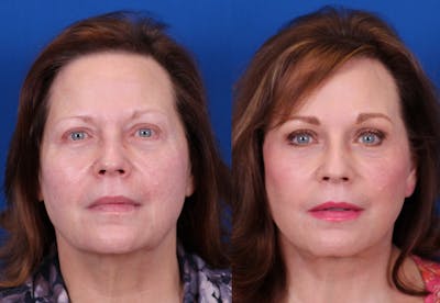 Brow Lift Before & After Gallery - Patient 405442 - Image 1