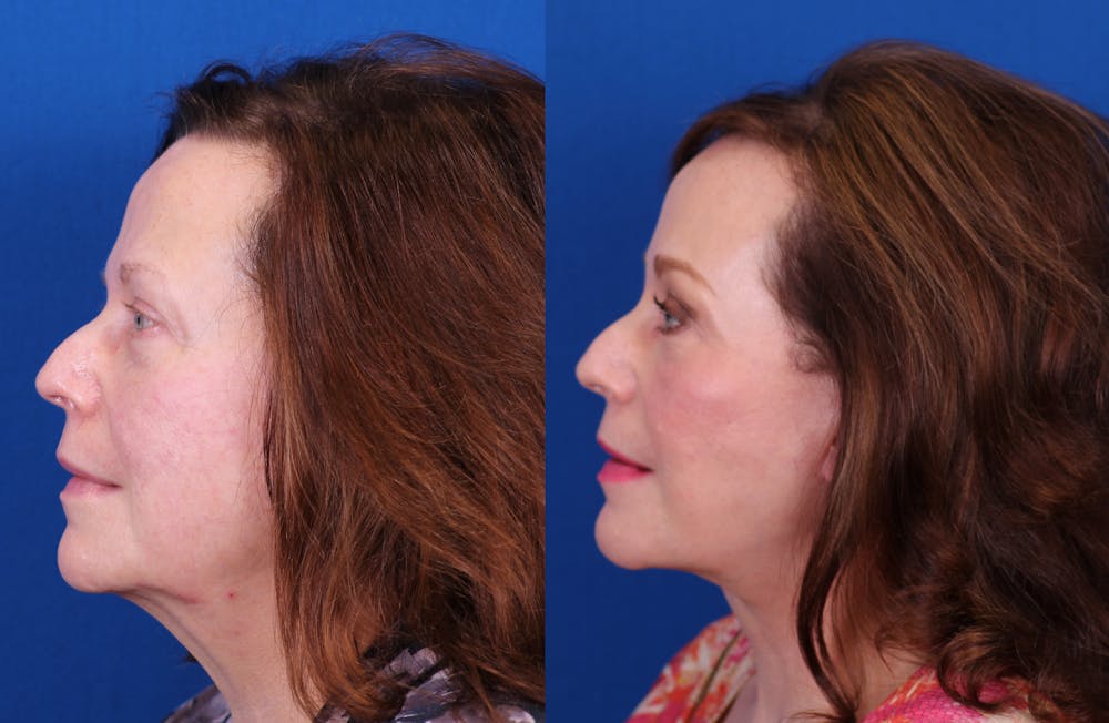 Brow Lift Before & After Gallery - Patient 405442 - Image 3