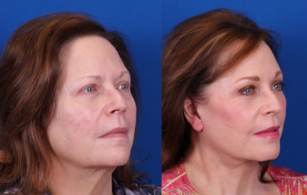 Brow Lift Before & After Gallery - Patient 405442 - Image 2