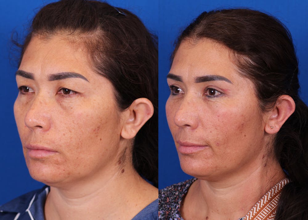 Blepharoplasty Before & After Gallery - Patient 136439 - Image 3