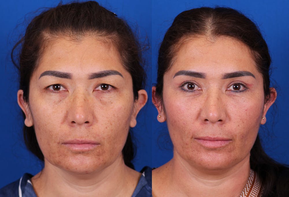 Blepharoplasty Before & After Gallery - Patient 136439 - Image 1