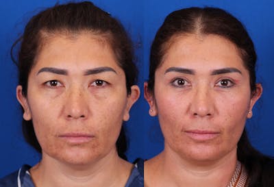 Blepharoplasty Before & After Gallery - Patient 136439 - Image 1