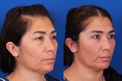 Blepharoplasty Before & After Gallery - Patient 136439 - Image 2