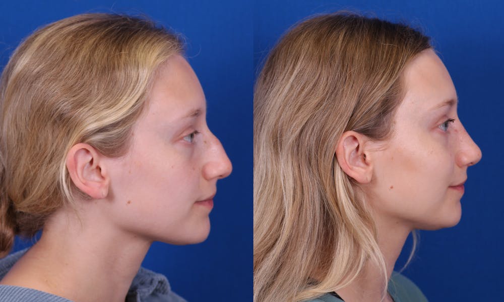 Rhinoplasty Before & After Gallery - Patient 210554 - Image 1