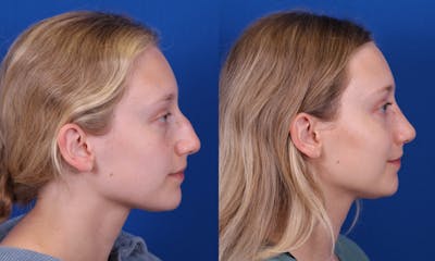 Rhinoplasty Before & After Gallery - Patient 210554 - Image 1