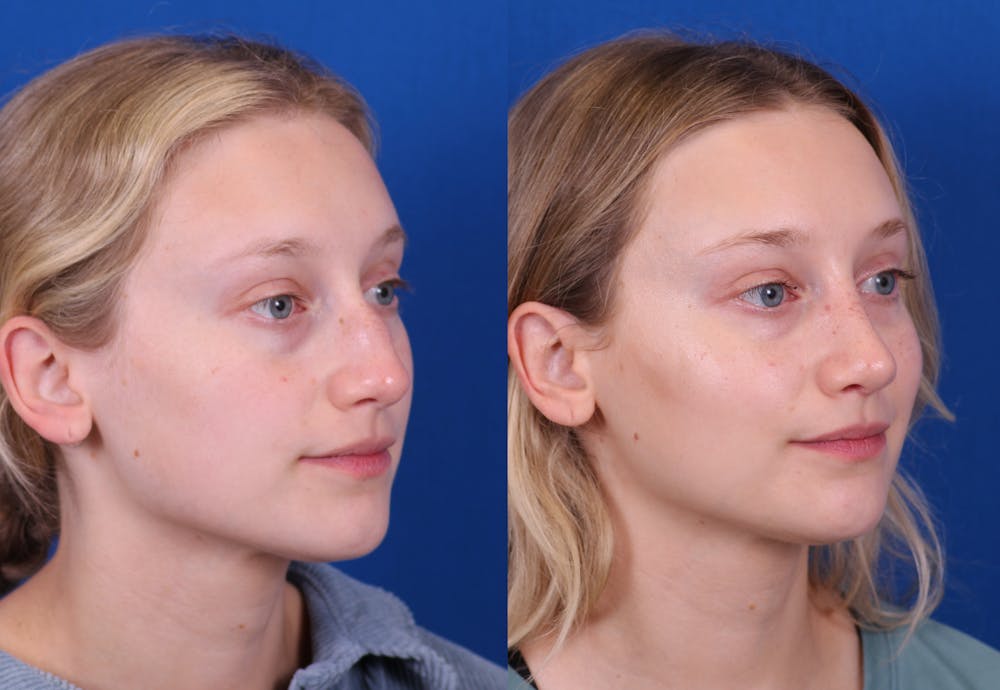 Rhinoplasty Before & After Gallery - Patient 210554 - Image 2
