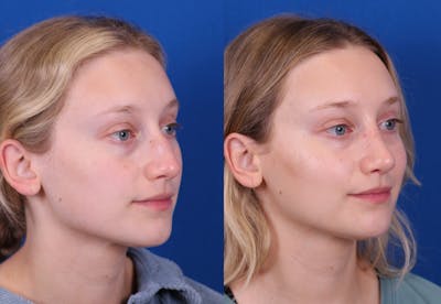 Rhinoplasty Before & After Gallery - Patient 210554 - Image 2