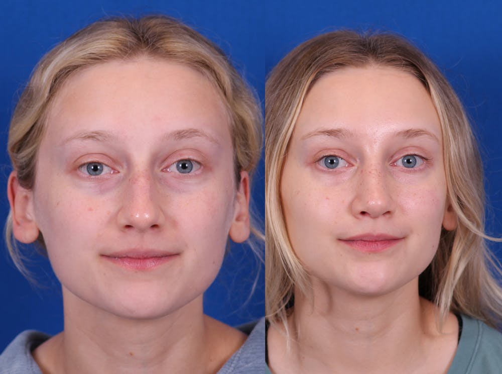 Rhinoplasty Before & After Gallery - Patient 210554 - Image 3