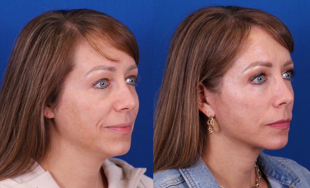 Facelift/Neck Lift Before & After Gallery - Patient 385677 - Image 2