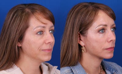 Facelift/Neck Lift Before & After Gallery - Patient 385677 - Image 2