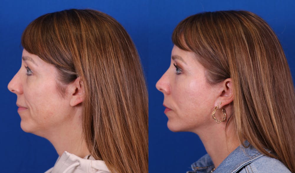 Facelift/Neck Lift Before & After Gallery - Patient 385677 - Image 3