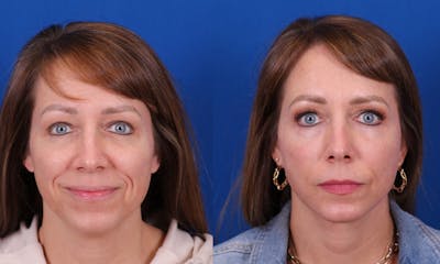 Facelift/Neck Lift Before & After Gallery - Patient 385677 - Image 1