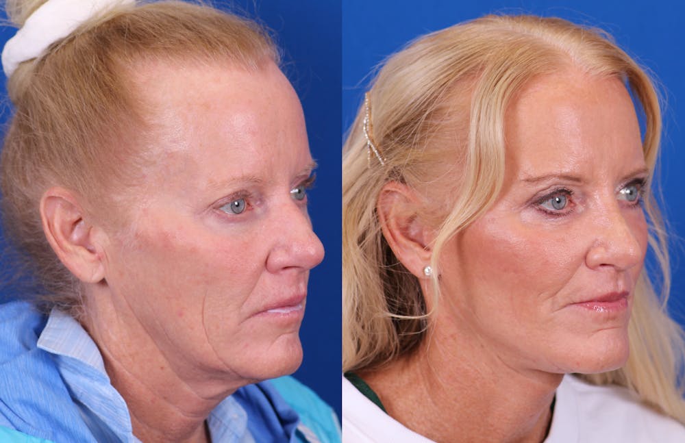 Facelift/Neck Lift Before & After Gallery - Patient 224088 - Image 2