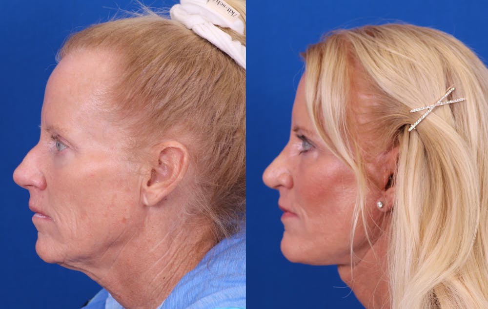 Facelift/Neck Lift Before & After Gallery - Patient 224088 - Image 3