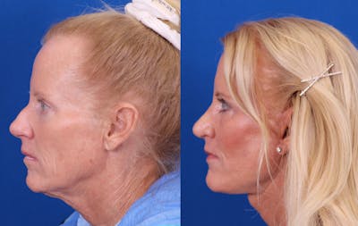 Rhinoplasty Before & After Gallery - Patient 182902 - Image 1