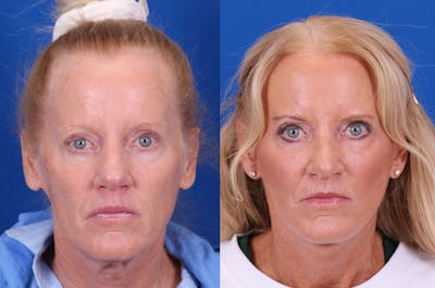 Facelift/Neck Lift Before & After Gallery - Patient 224088 - Image 1