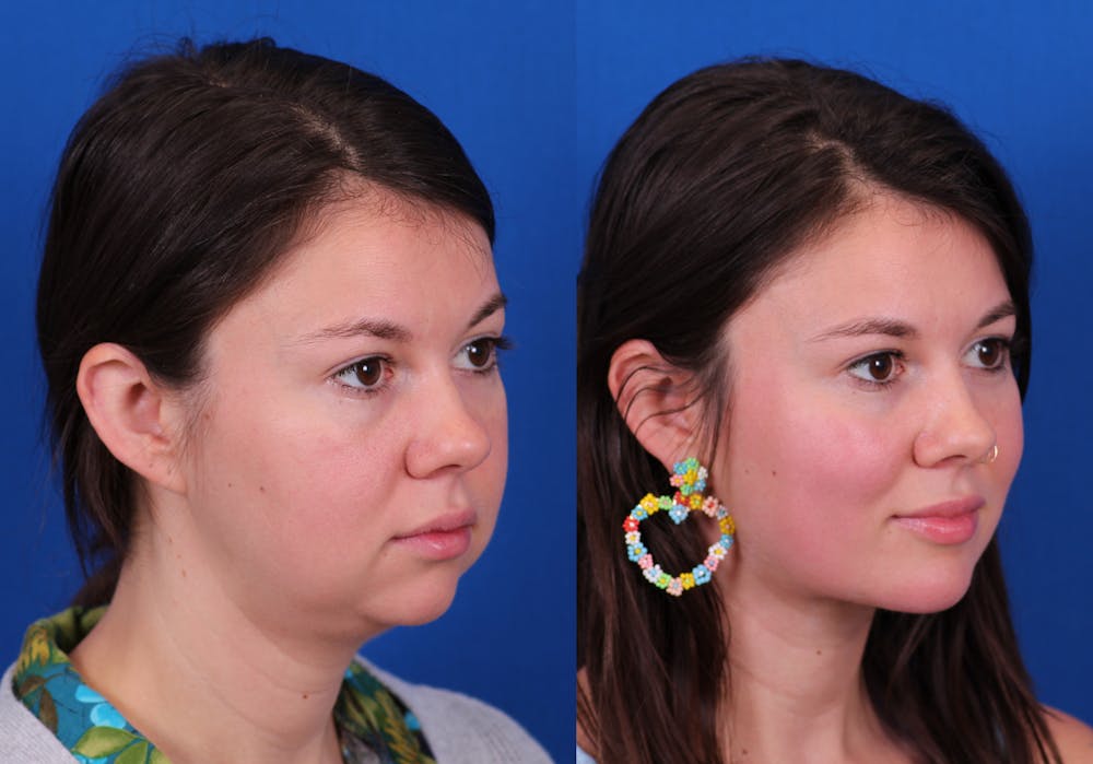 Neck deFINE Before & After Gallery - Patient 341323 - Image 1