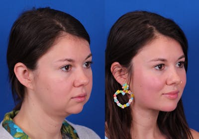 Neck deFINE Before & After Gallery - Patient 341323 - Image 1