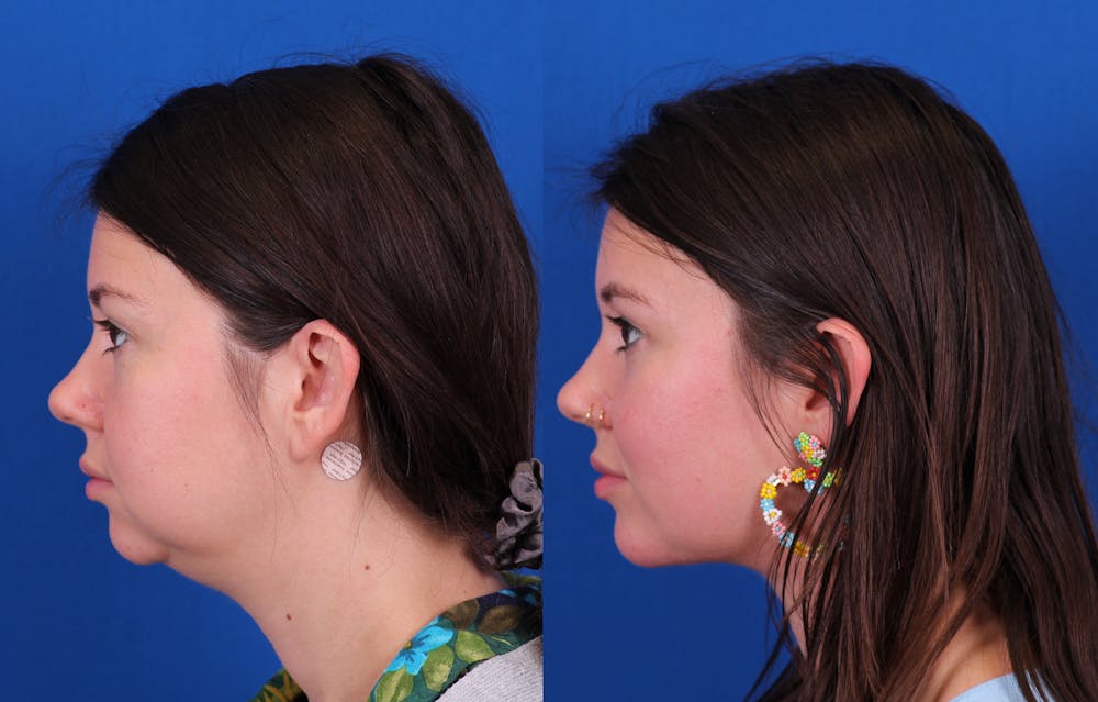 Neck deFINE Before & After Gallery - Patient 341323 - Image 3