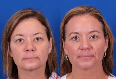 Blepharoplasty Before & After Gallery - Patient 478024 - Image 1