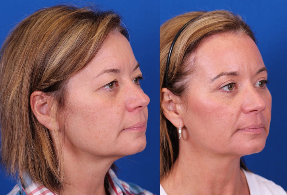 Brow Lift Before & After Gallery - Patient 269721 - Image 3