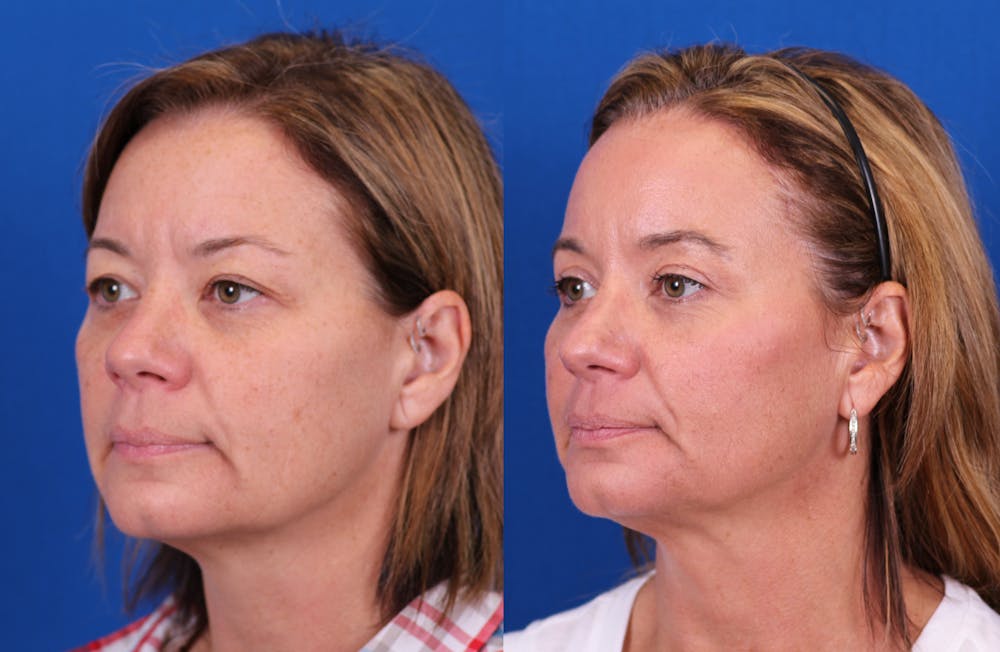 Brow Lift Before & After Gallery - Patient 269721 - Image 2